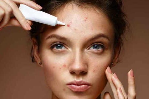 Ways to get rid of hormonal acne